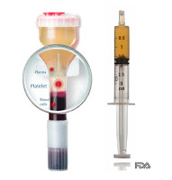 Hamstring Gluoro Injection Study Spotlight: PRP Injection in Reducing Recovery Time in Acute ...